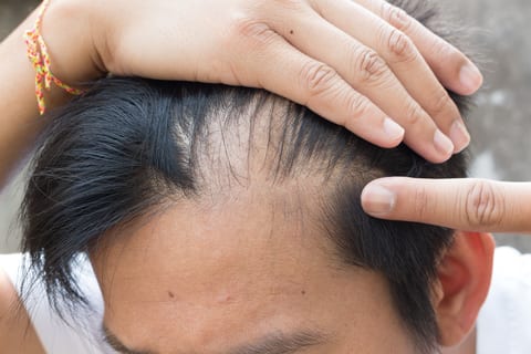 FUE Hair Transplant