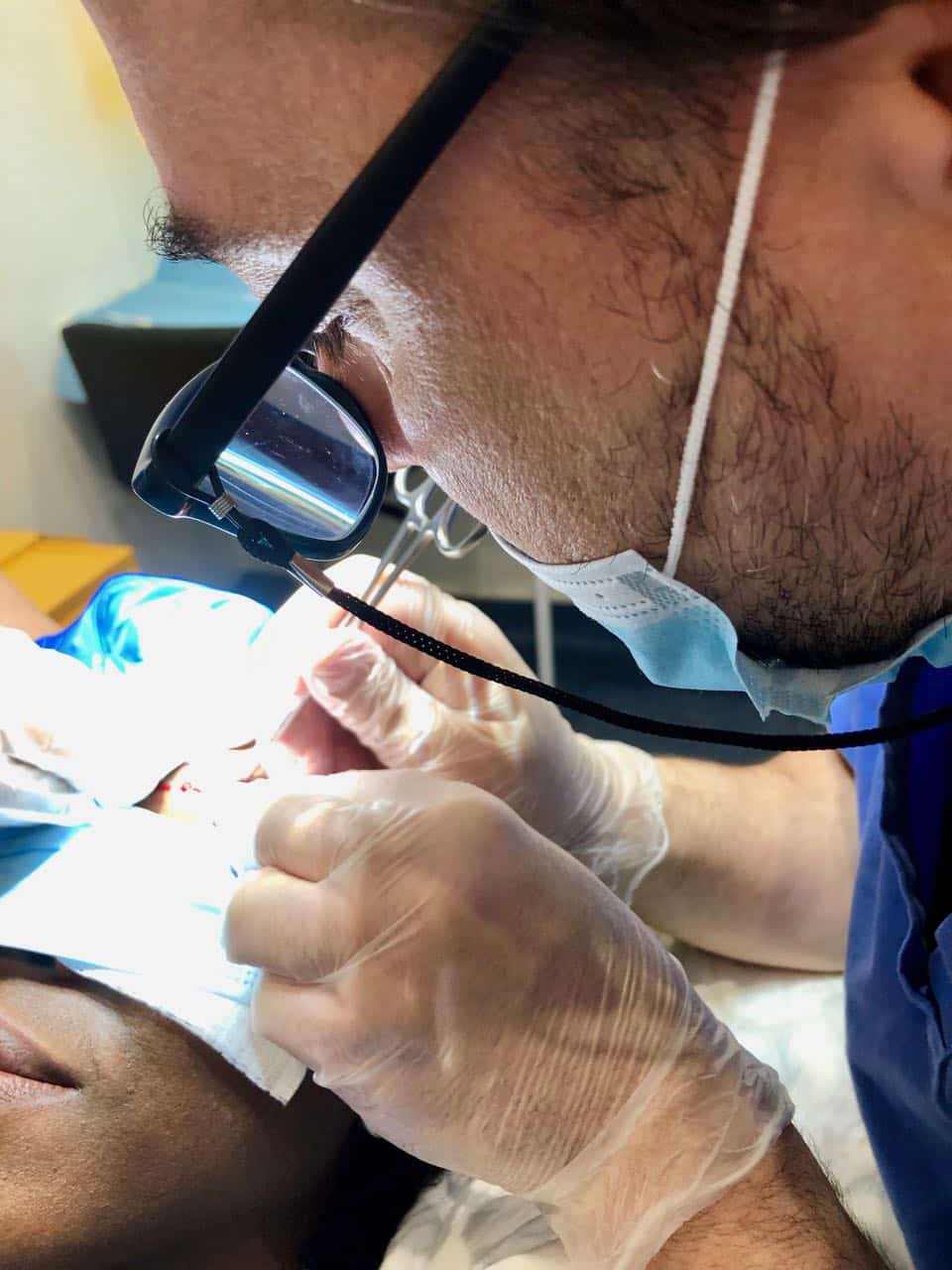 afro eyebrow transplant Dr Sciacca implants