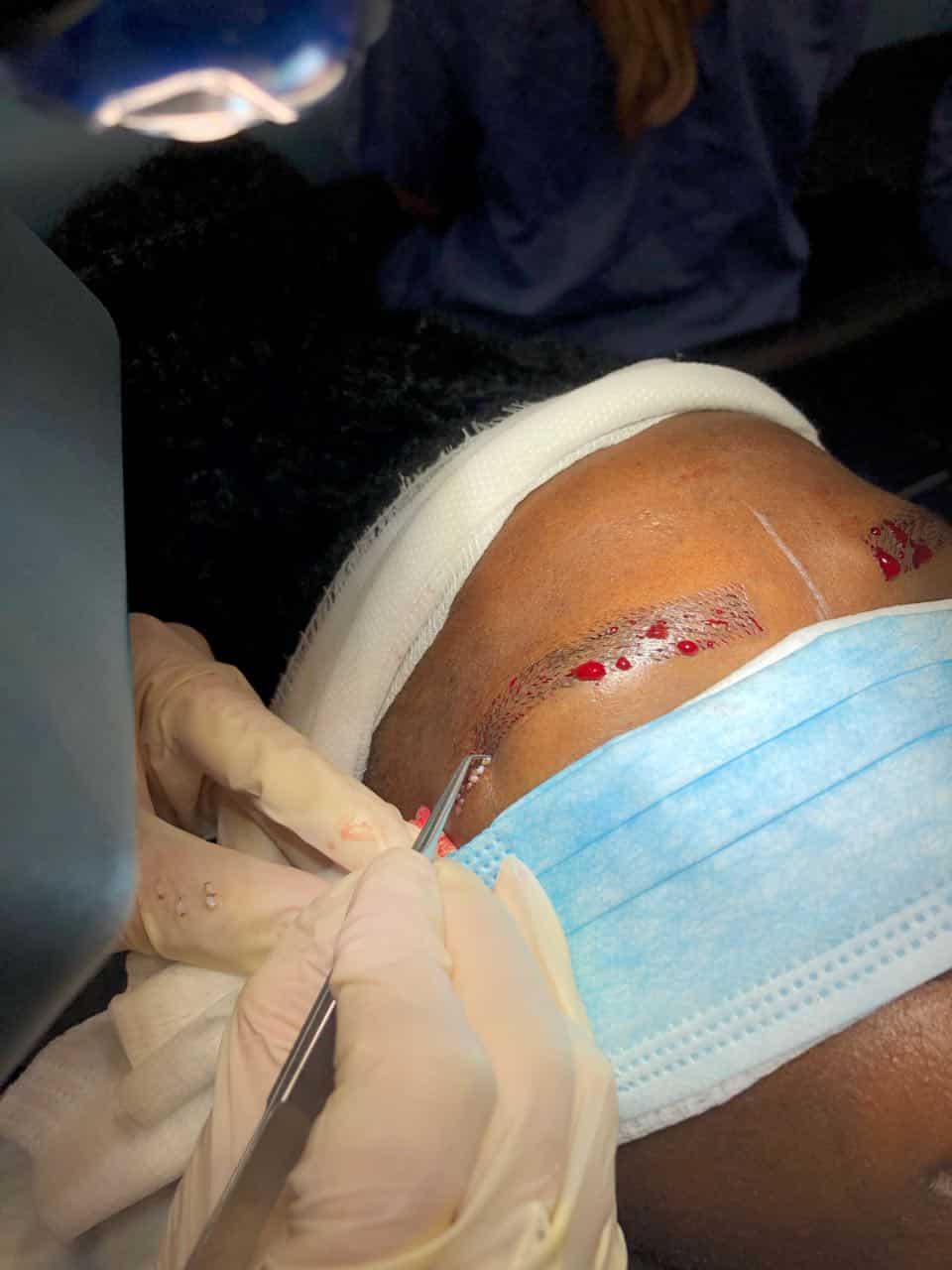 afro eyebrow transplant implants our clinic