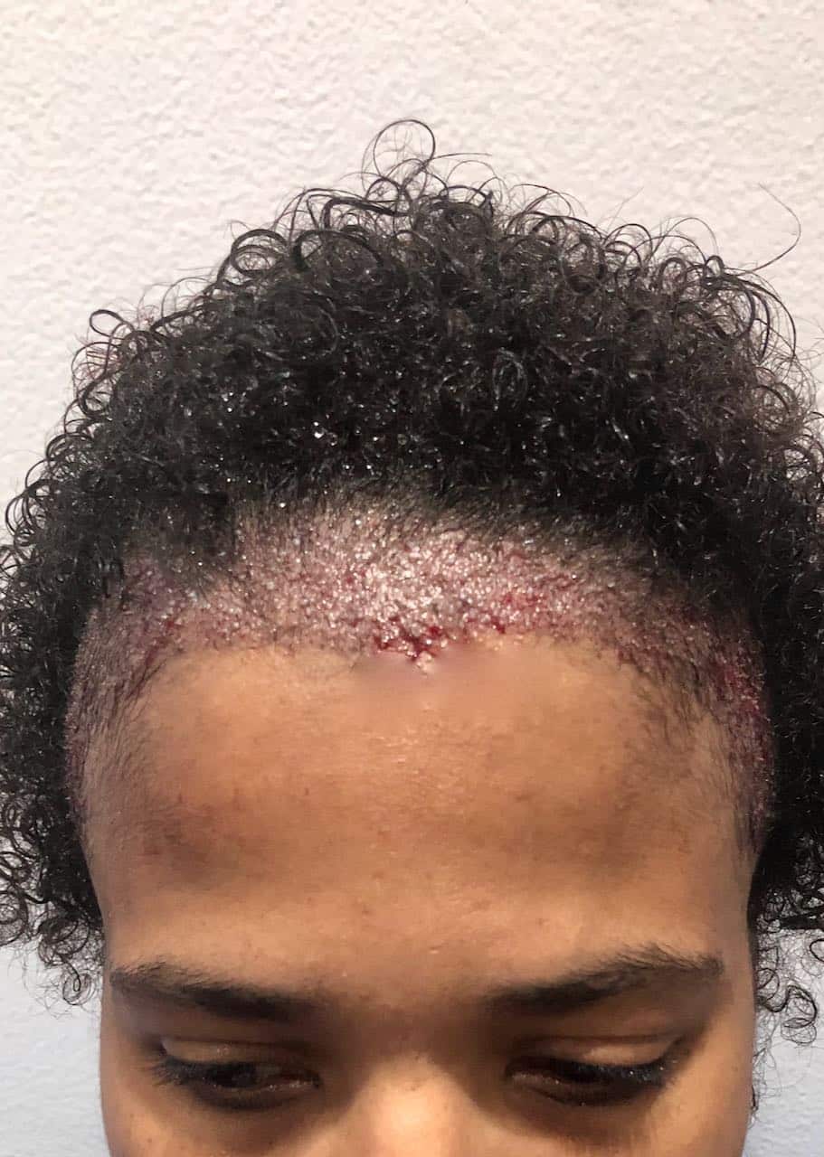 afro transplant after procedure