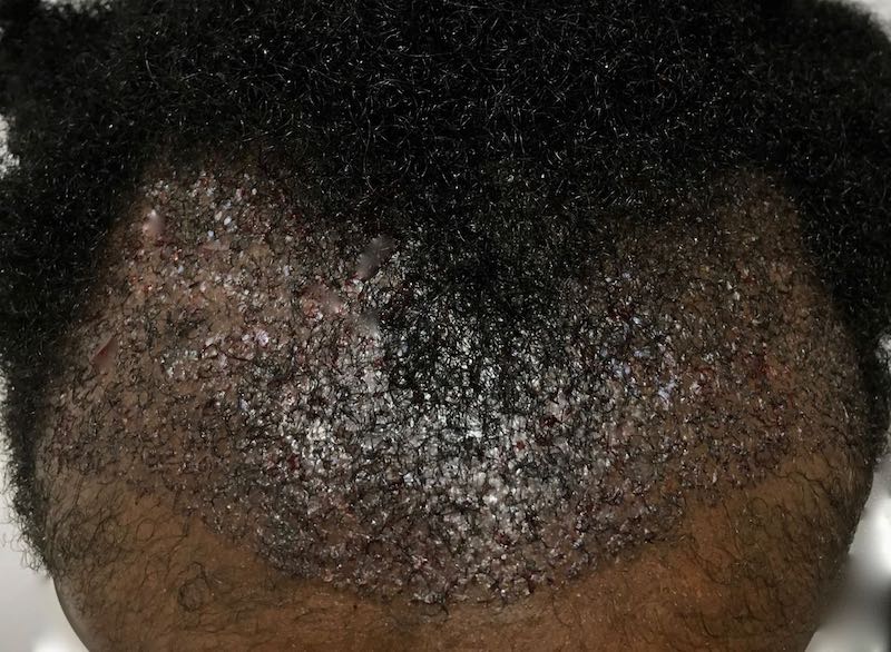 Afro Hair surgery