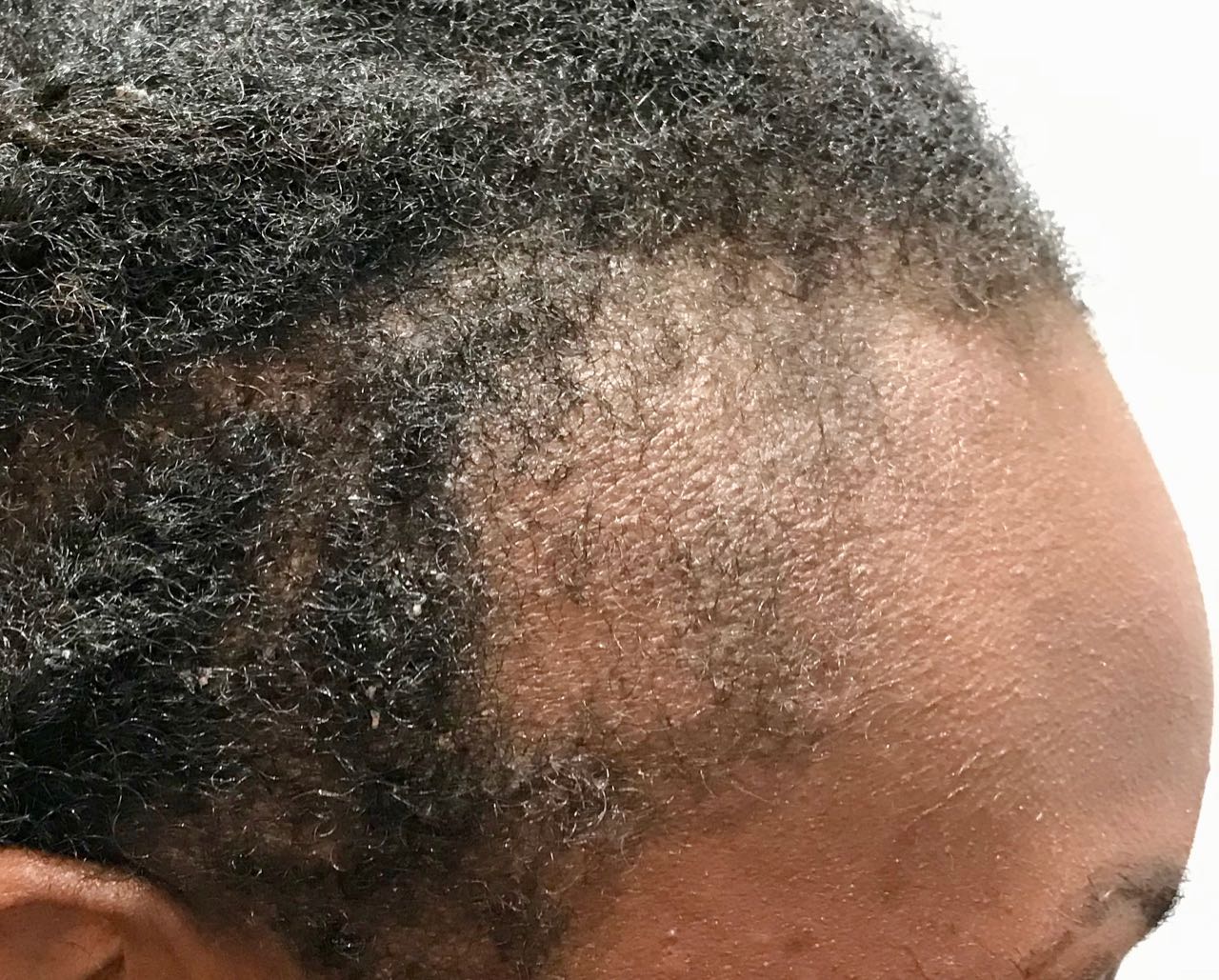afro hair surgery before right temple