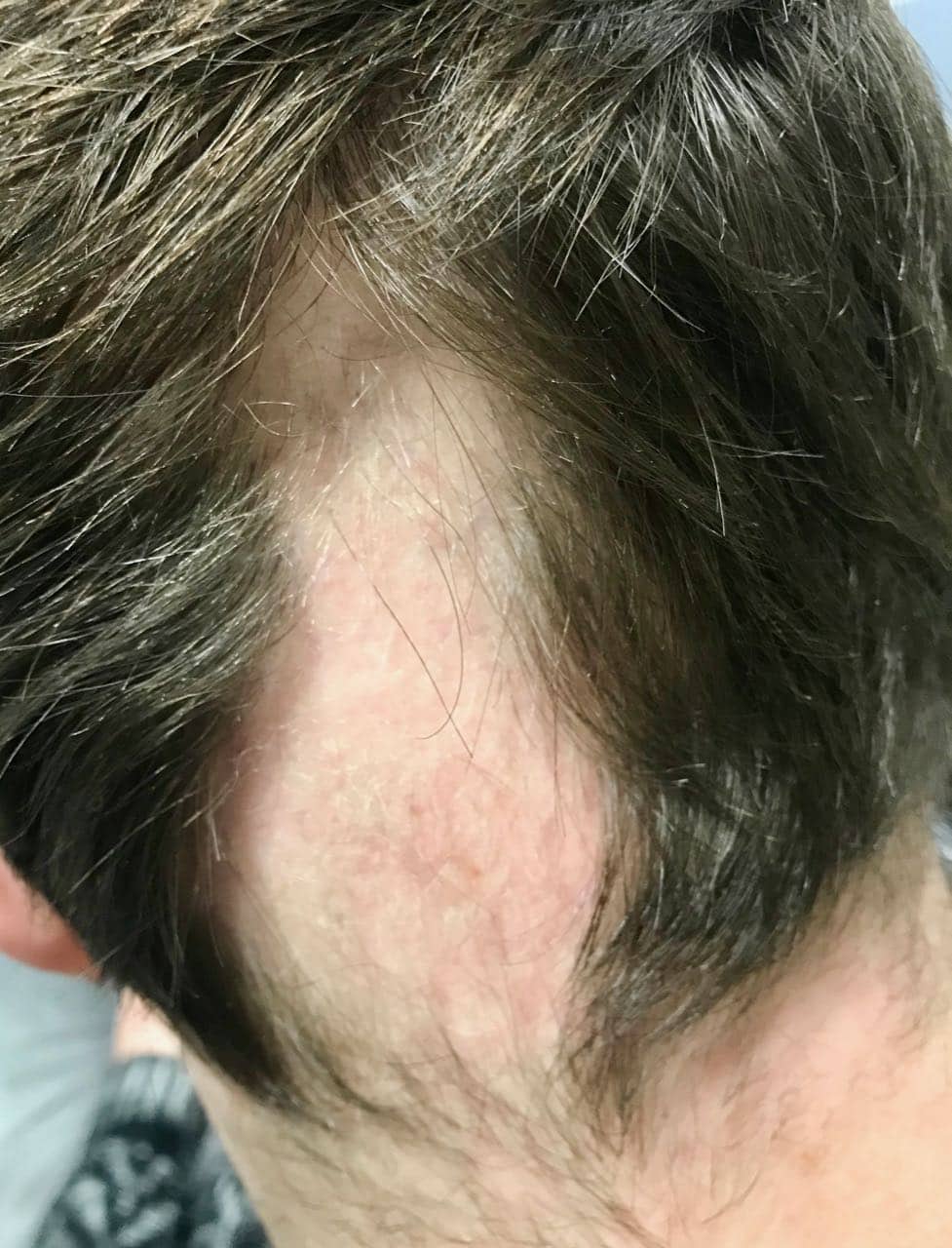 alopecia areata
