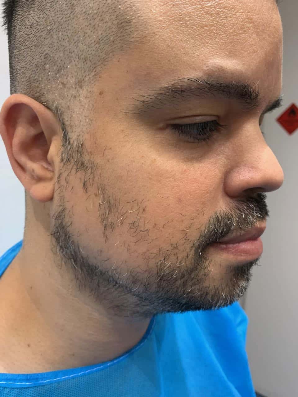 Beard transplant Rick pre op right