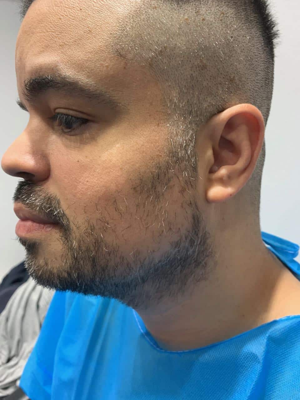 beard transplant left side pre op