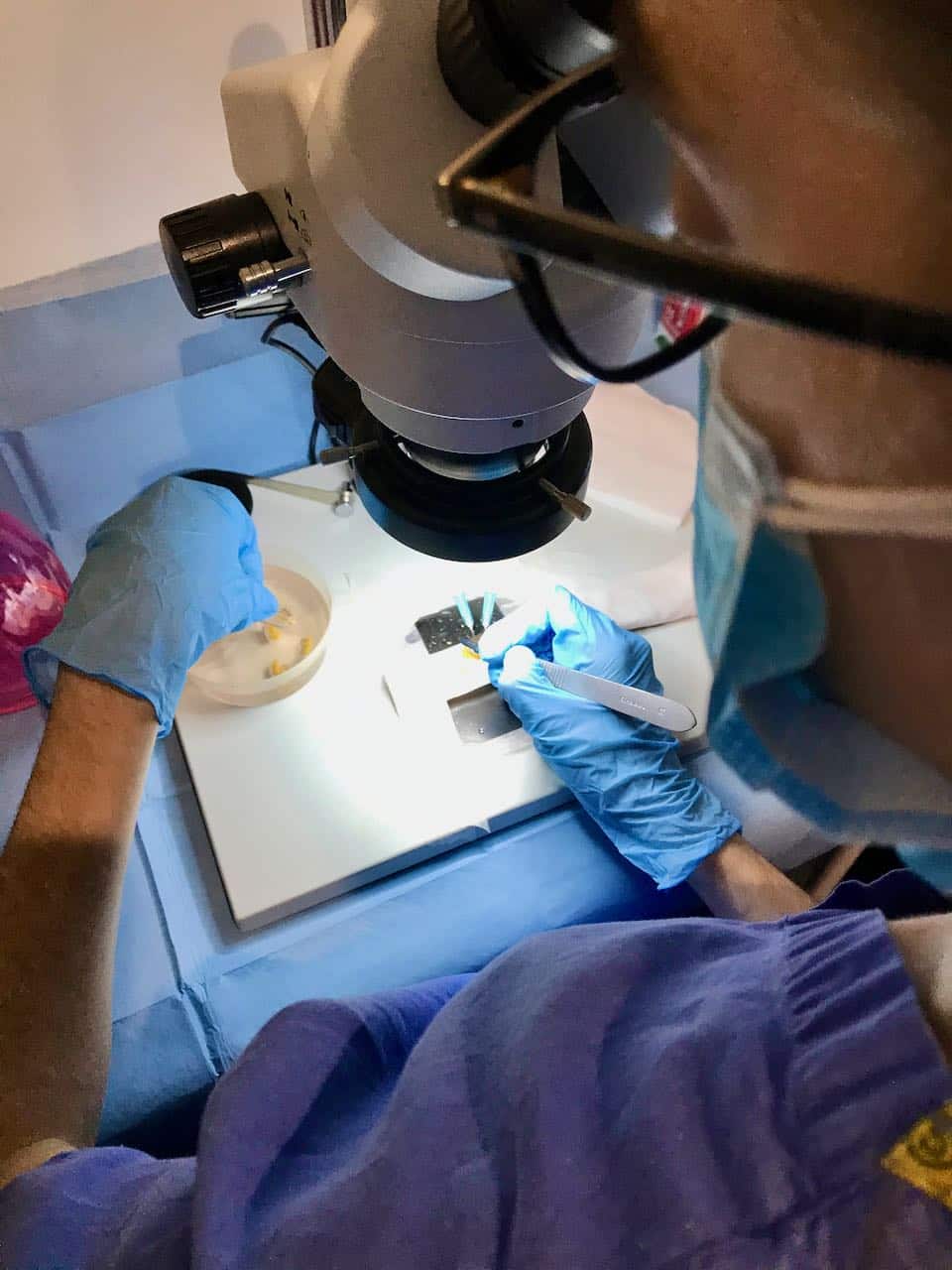 beard surgery shaping the grafts