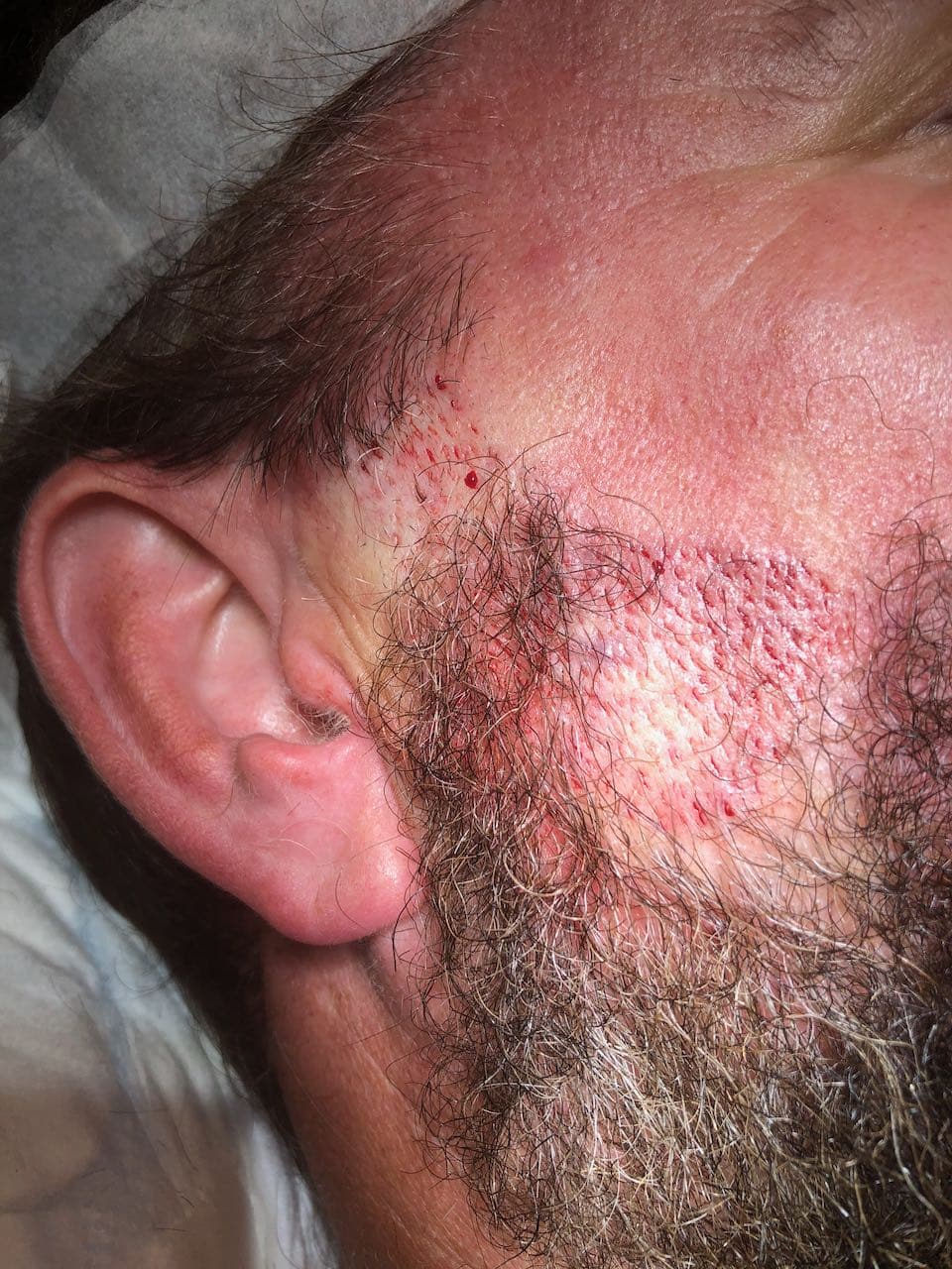 beard transplant incisions prior to planting