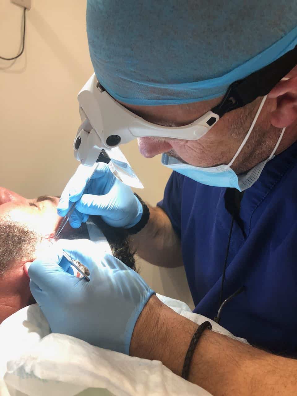 beard transplant plancing the beard grafts