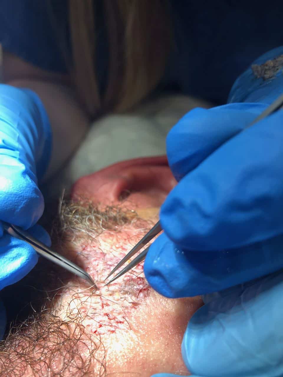beard transplant