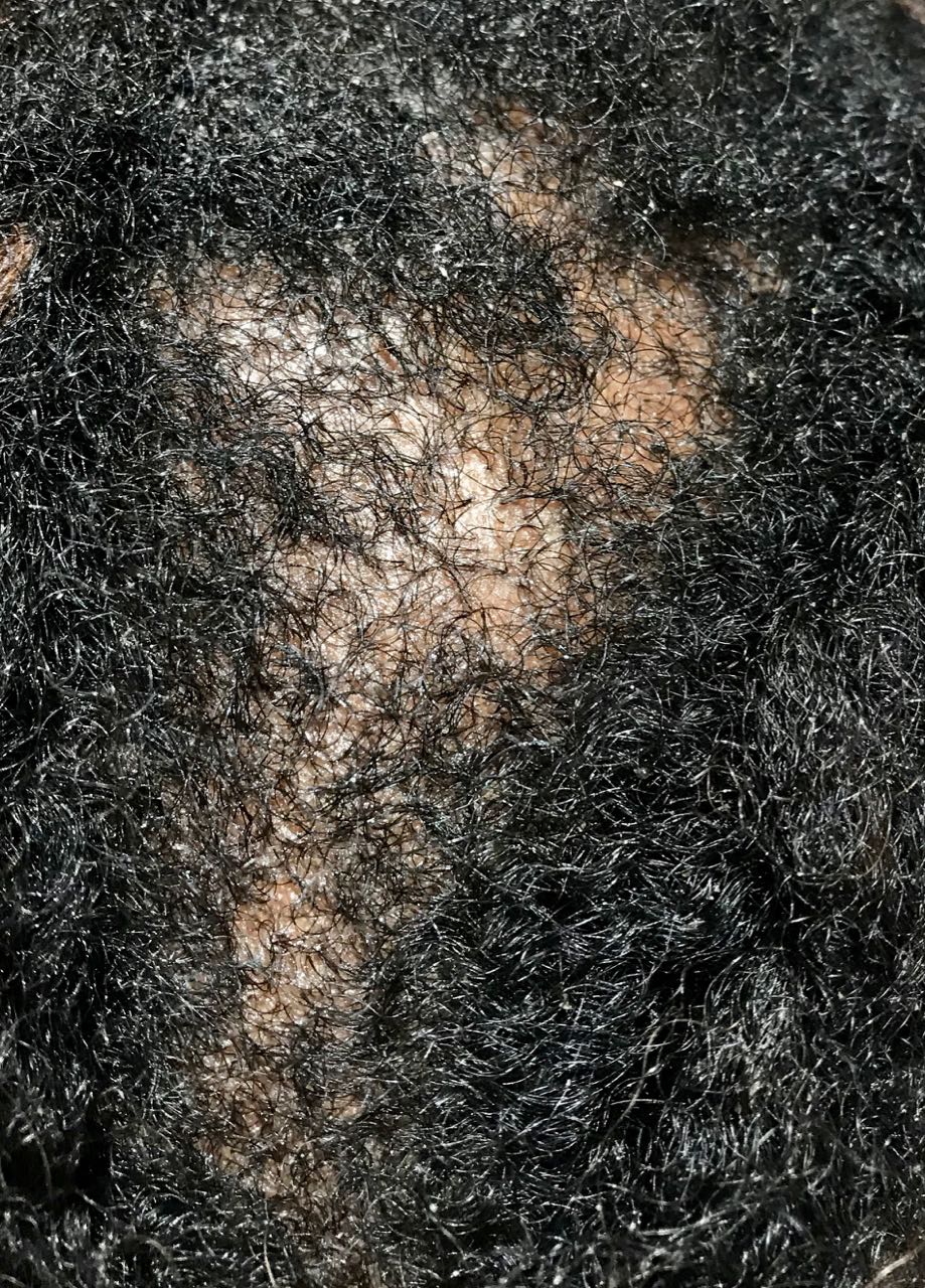 dandruff afro