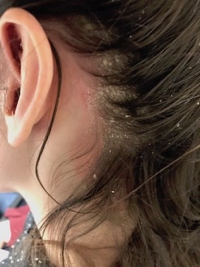 dandruff