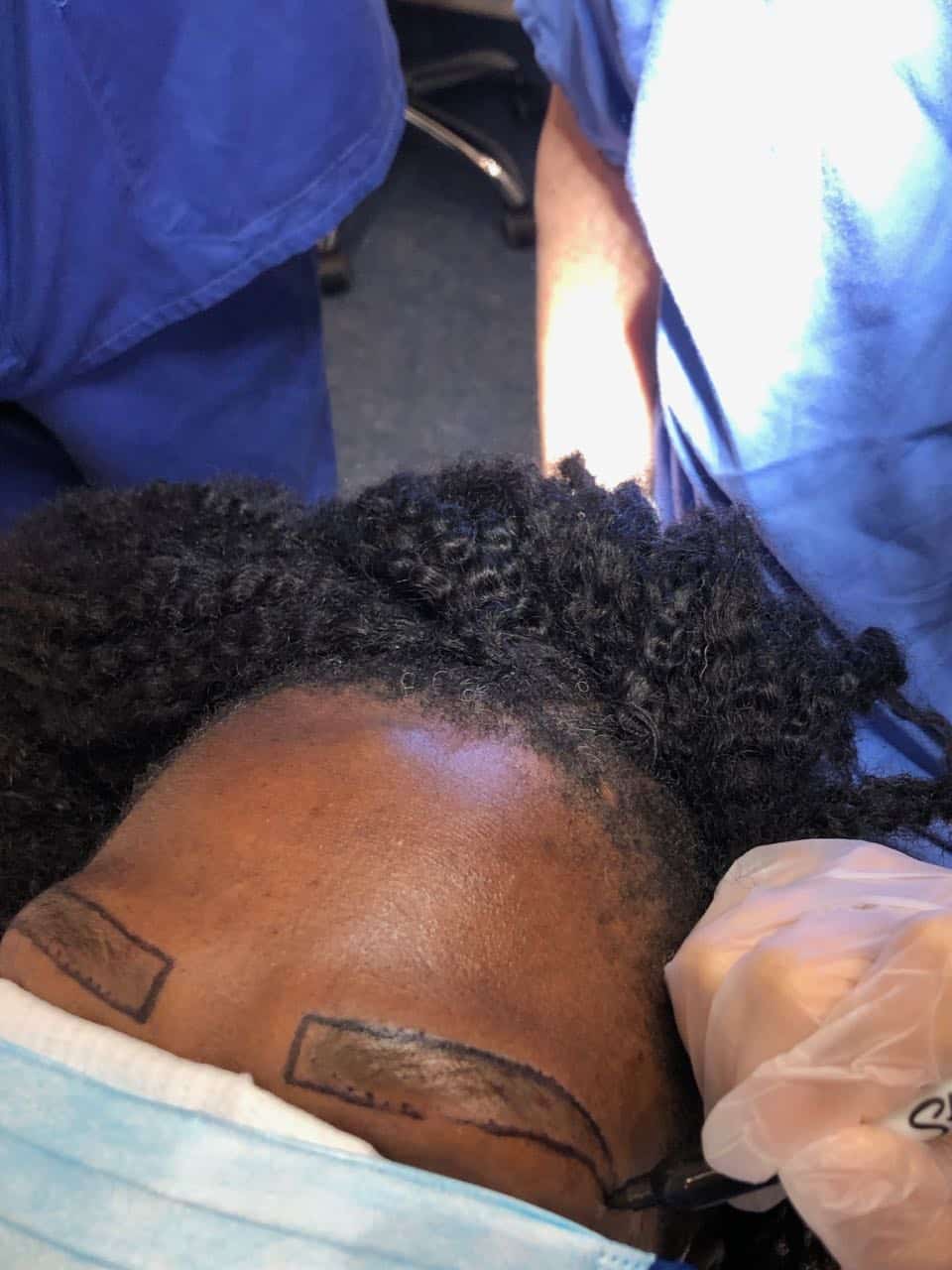 eyebrow transplant afro