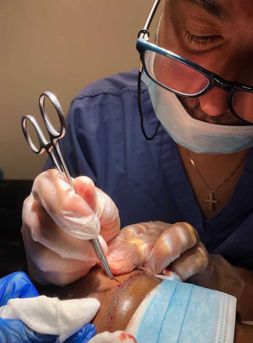 afro eyebrow transplant incision photo