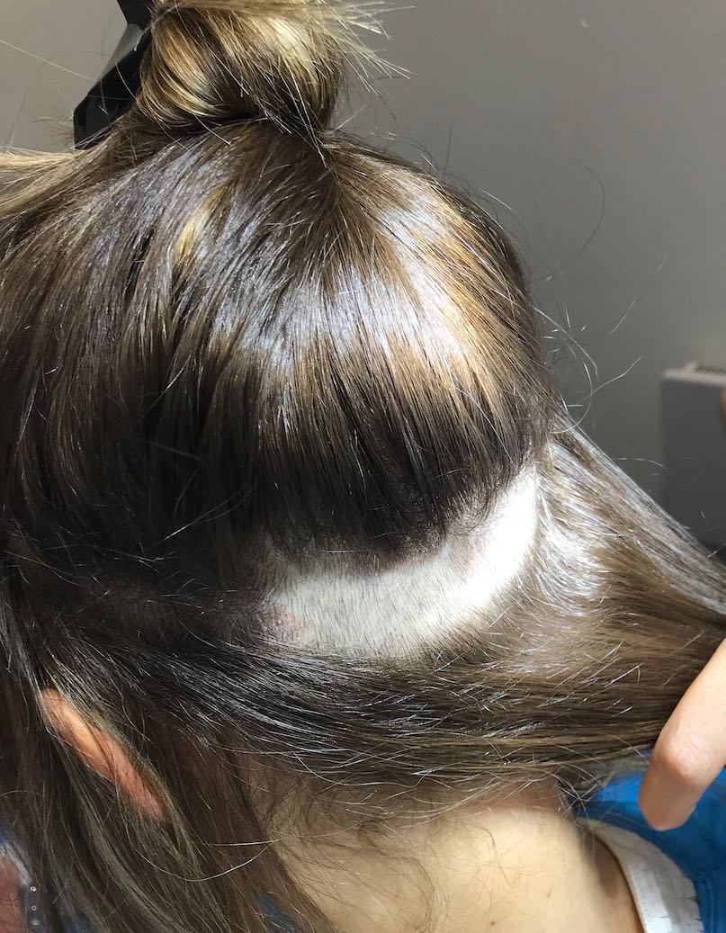 eyebrow surgery hair shave