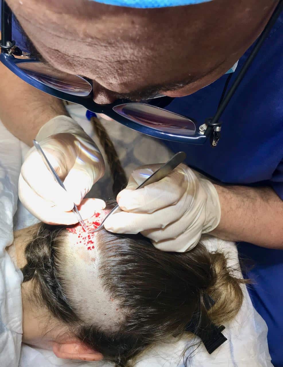 eyebrow surgery Dr Sciacca Extraction