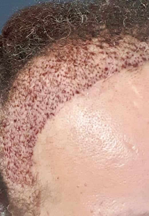 afro hair surgery right temporal post