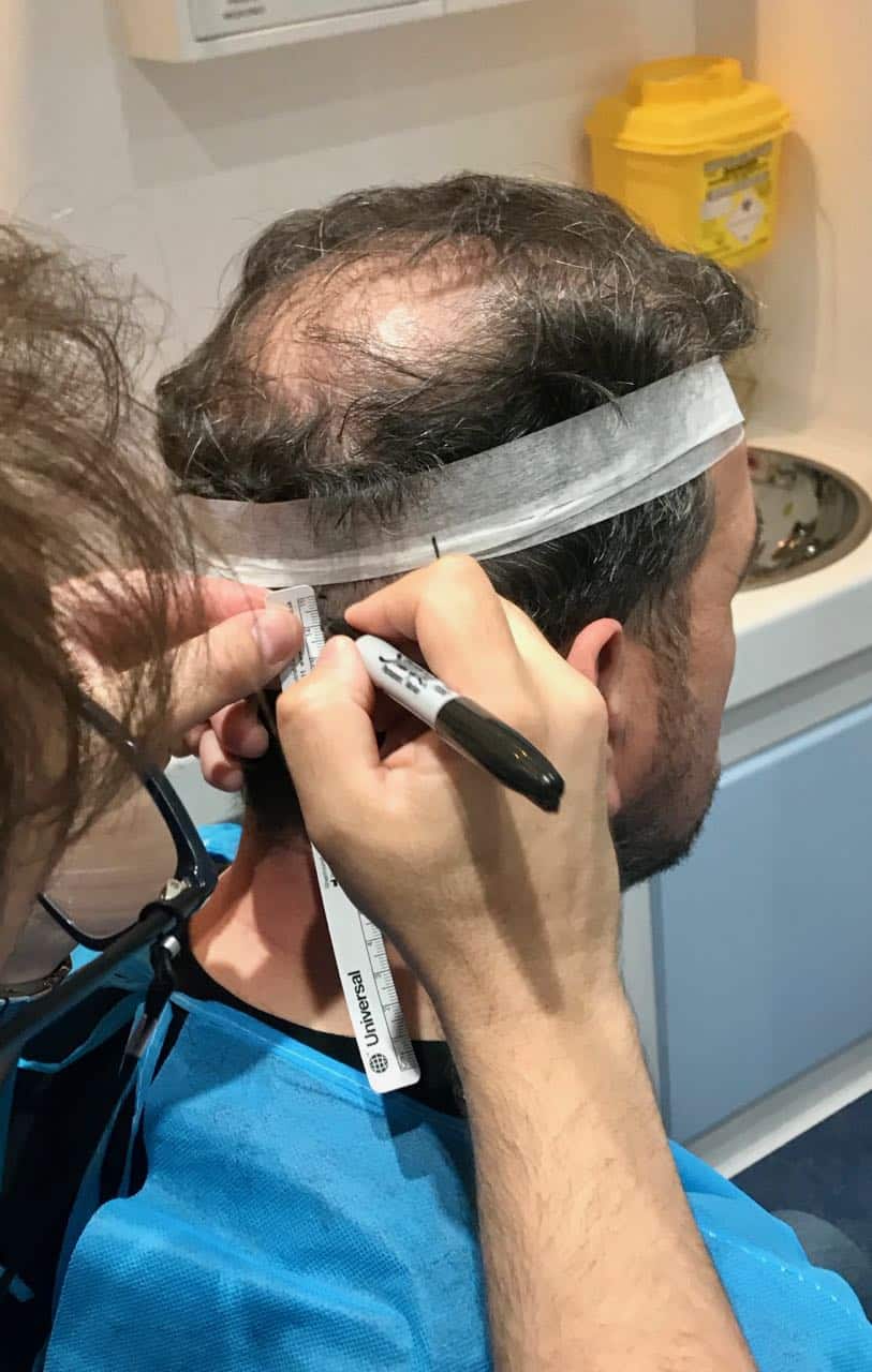 fut hair transplant drawing the strip