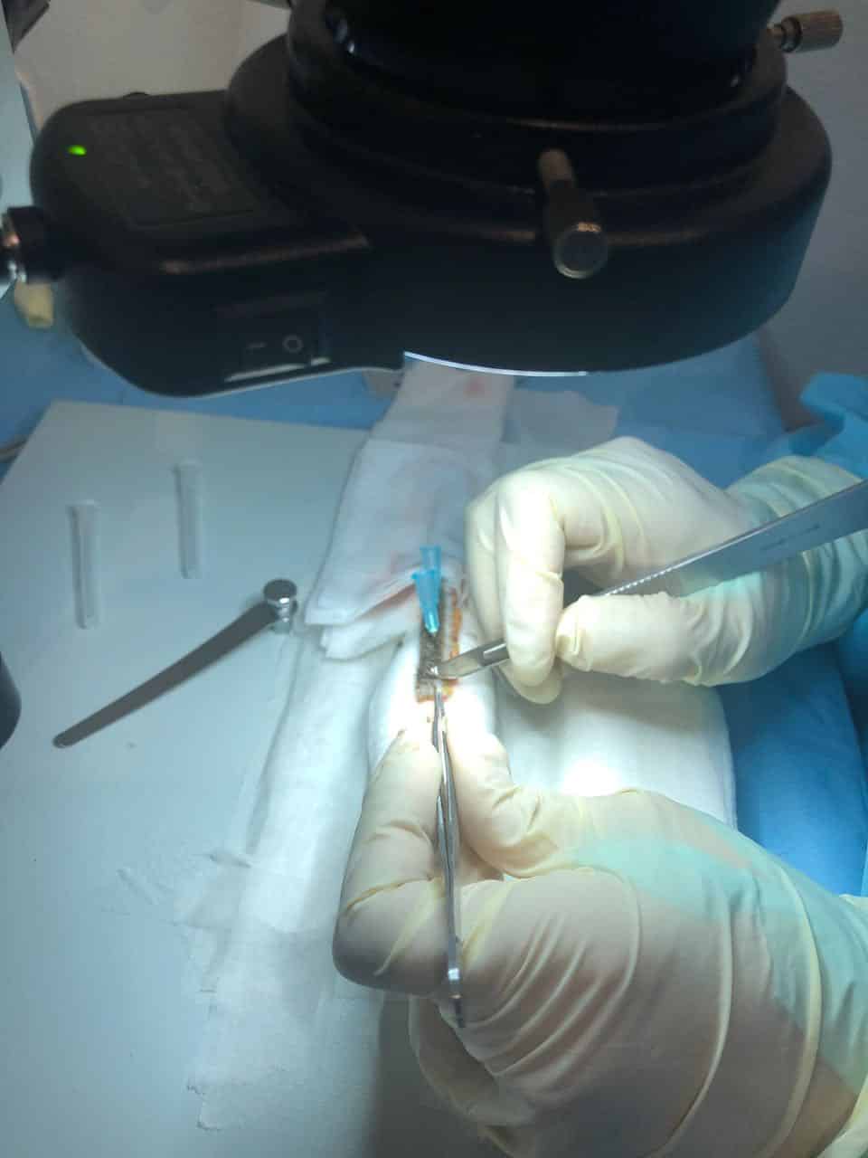 fut hair transplant afro cutting the strip