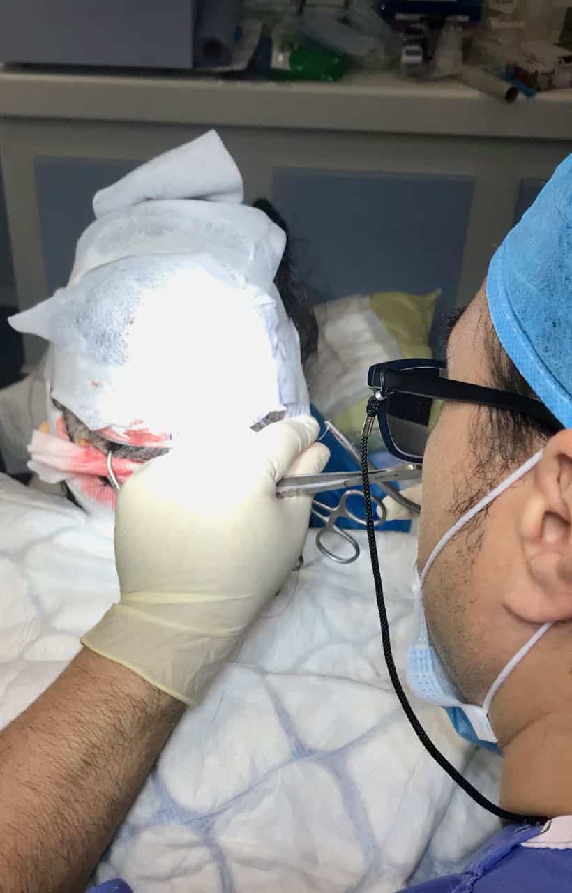 fut hair transplant the stitching process