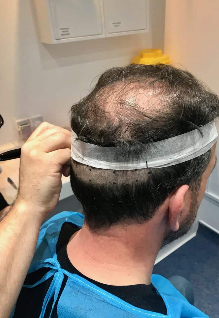 fut hair transaplant drawing the strip
