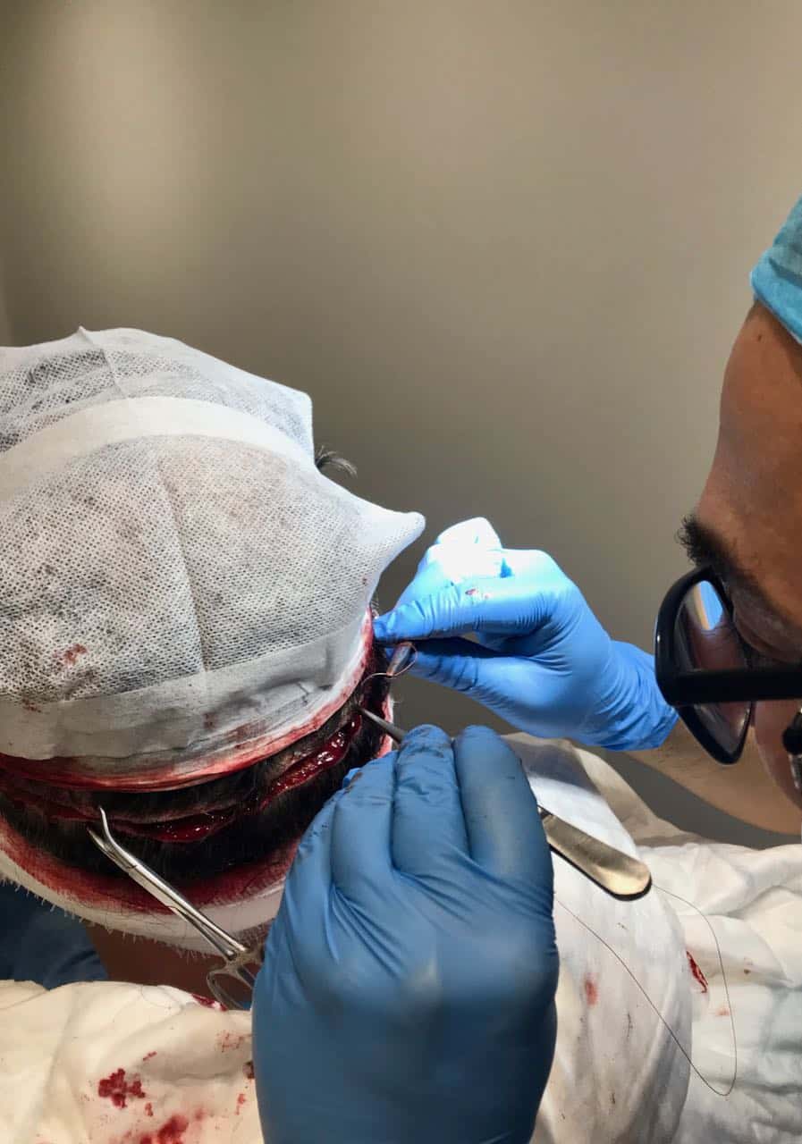 fut hair transplant the strip