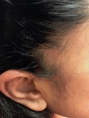 hair loss our clinic