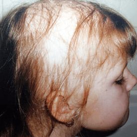 Hair Loss Vitamin b12