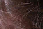 head lice