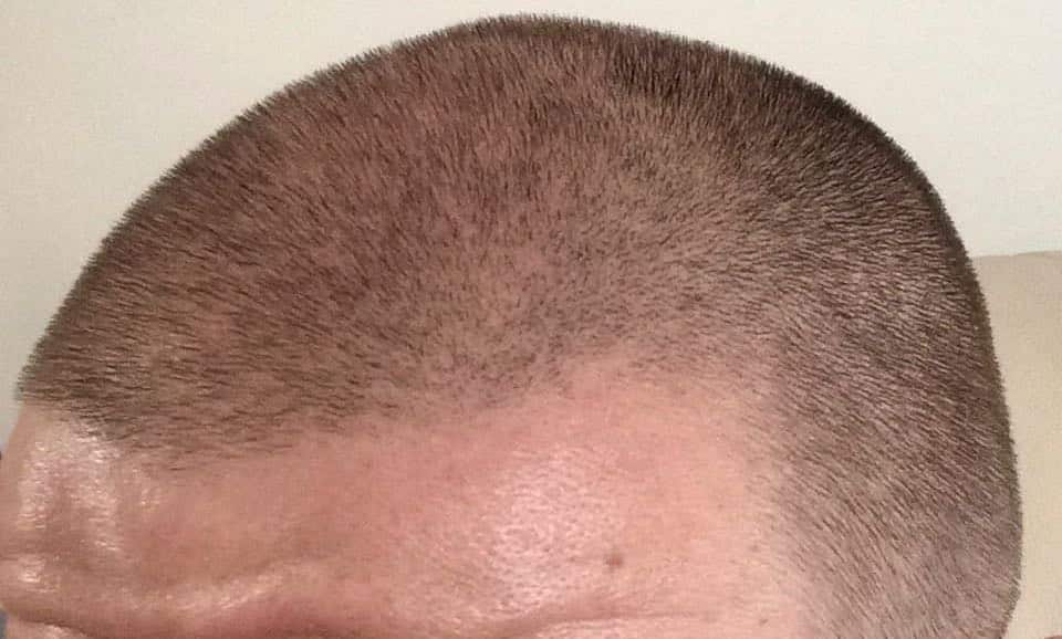 male pattern baldness
