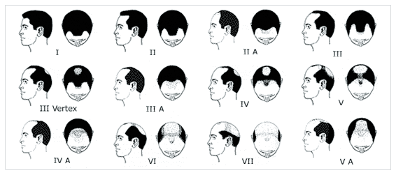 norwood hamilton scale crown loss