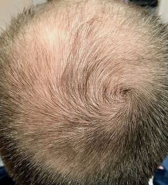 hair loss male pattern