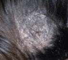 child ringworm