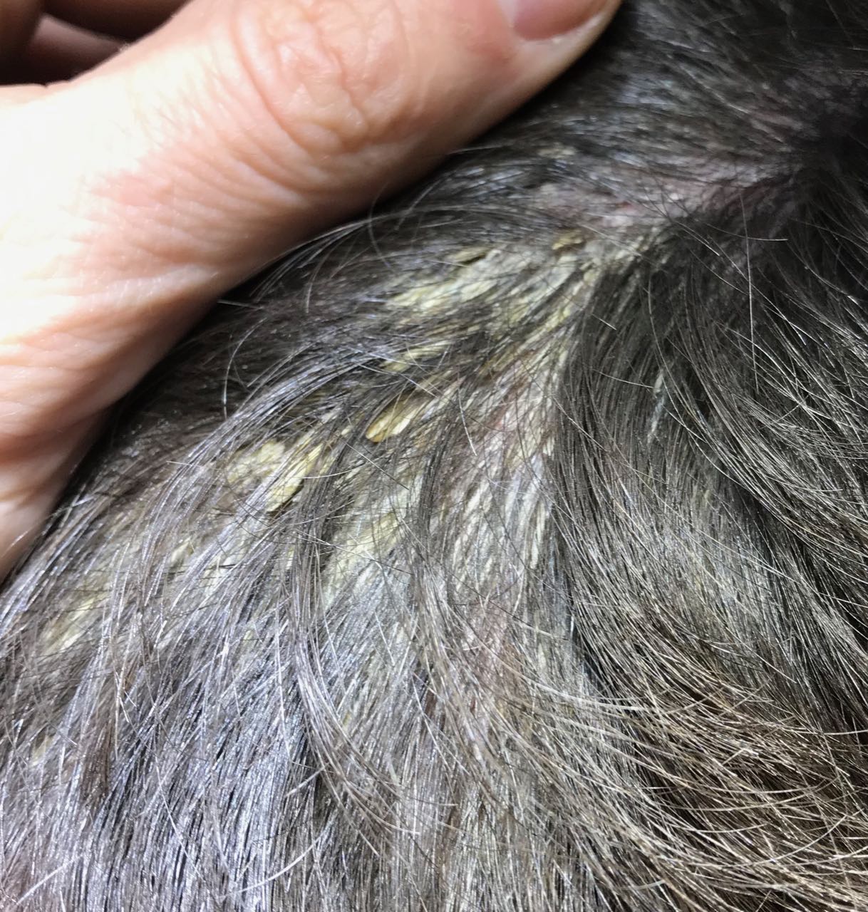 psoriasis pre treatment