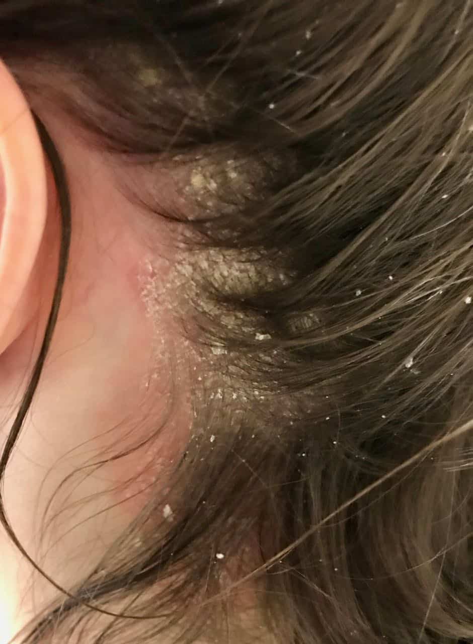 scalp psoriasis above ear