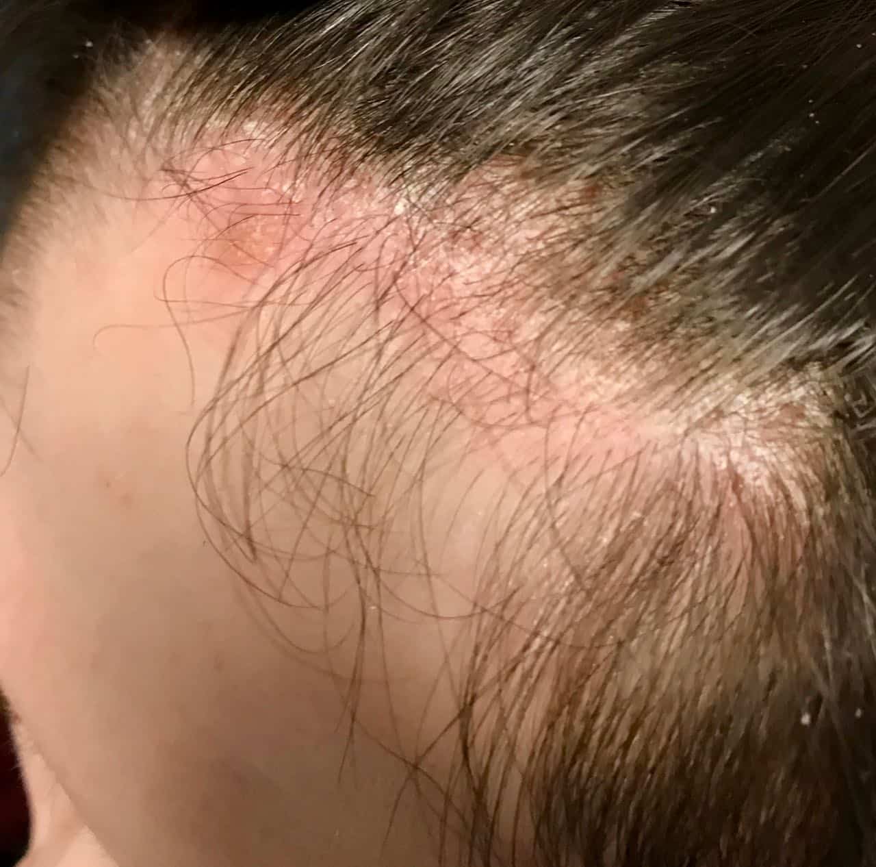 scalp psoriasis forehead