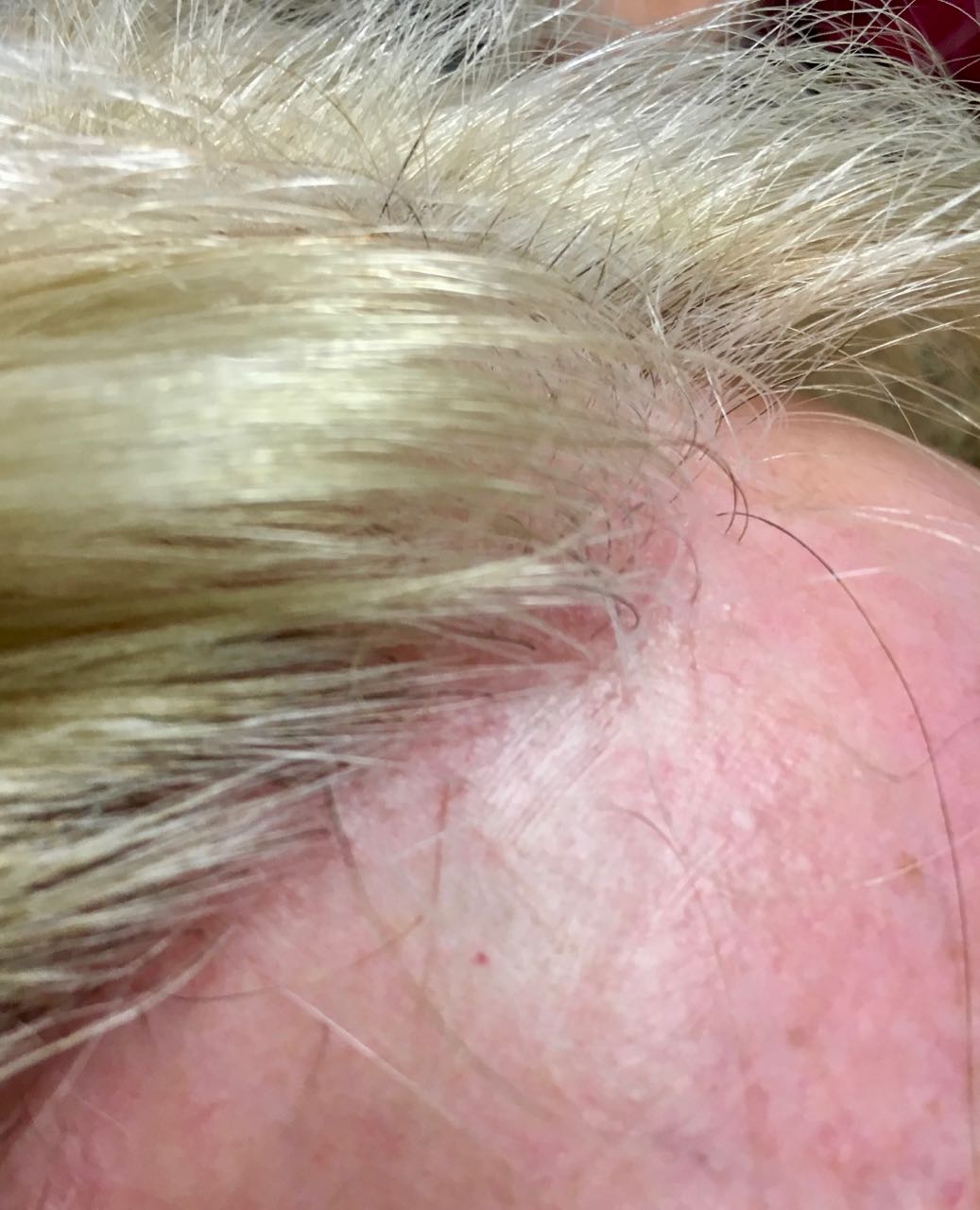scarrng alopecia