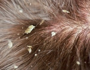 Seborrhoeic Dermatitis